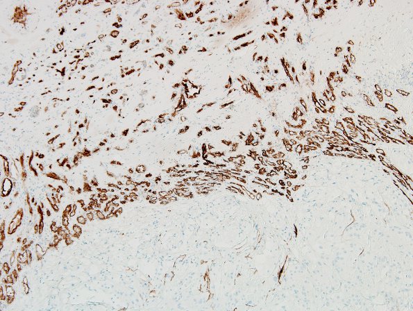 6D1 Meningioma, angiomatous, xanthomatous (Case 6) CD34 3.jpg