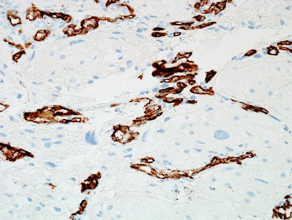 6D3 Meningioma, angiomatous, xanthomatous (Case 6) CD34 8.jpg