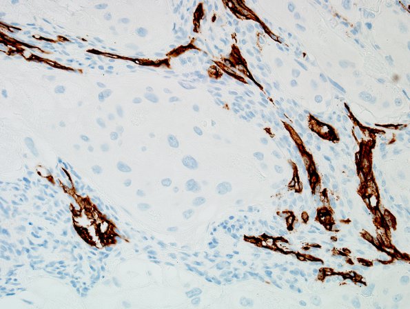 6D4 Meningioma, angiomatous, xanthomatous (Case 6) CD34 7.jpg