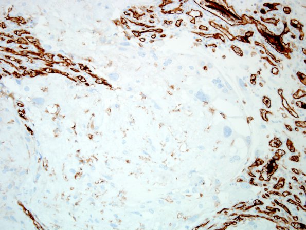 6E1 Meningioma, angiomatous, xanthomatous (Case 6) CD31 4.jpg