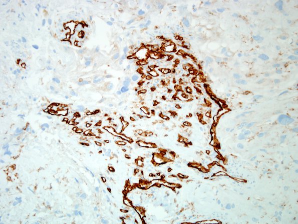 6E2 Meningioma, angiomatous, xanthomatous (Case 6) CD31 2.jpg