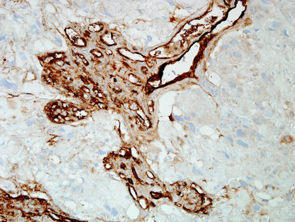 6F1 Meningioma, angiomatous, xanthomatous (Case 6) FactorVIII 2.jpg