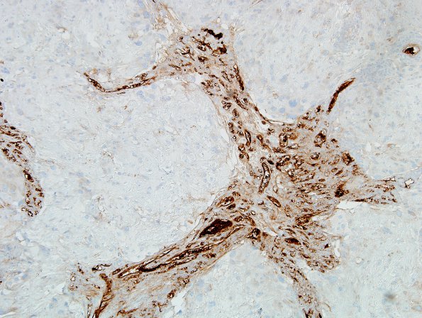 6F2 Meningioma, angiomatous, xanthomatous (Case 6) FactorVIII 1.jpg