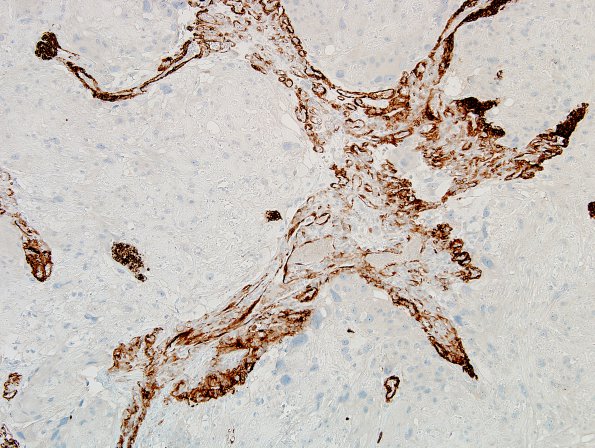 6G1 Meningioma, angiomatous, xanthomatous (Case 6) SMMS Myosin 3.jpg