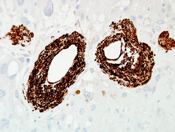 6G2 Meningioma, angiomatous, xanthomatous (Case 6) SMMS Myosin 1.jpg