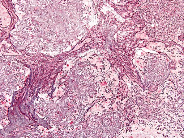 6H1 Meningioma, angiomatous, xanthomatous (Case 6) Retic 2.jpg