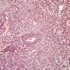 6H4 Meningioma, angiomatous, xanthomatous (Case 6) Retic 5.jpg