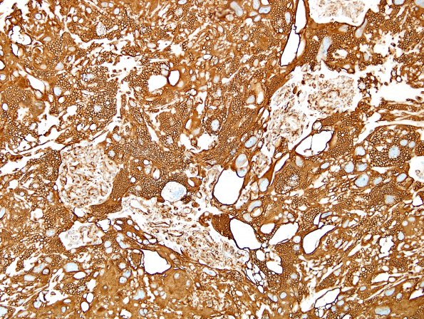 6I1 Meningioma, angiomatous, xanthomatous (Case 6) VIM 4.jpg