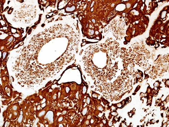 6I3 Meningioma, angiomatous, xanthomatous (Case 6) VIM 1.jpg