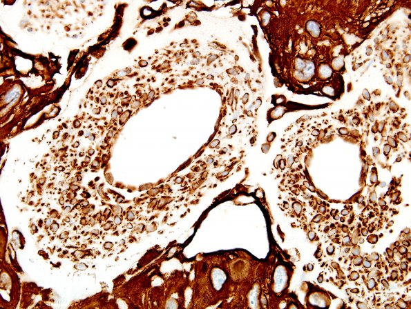 6I4 Meningioma, angiomatous, xanthomatous (Case 6) VIM 8.jpg