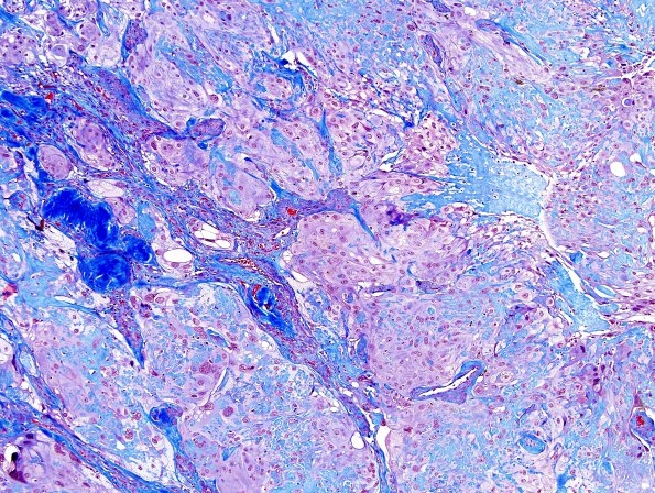 6J1 Meningioma, angiomatous, xanthomatous (Case 6) Trichrome 1.jpg