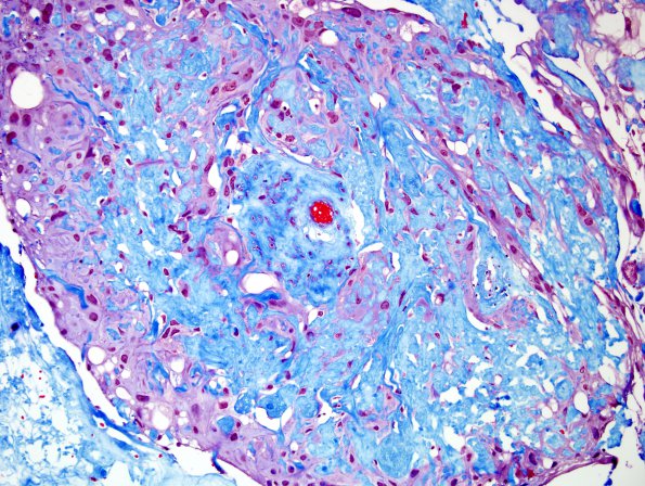 6J2 Meningioma, angiomatous, xanthomatous (Case 6) Trichrome 3.jpg