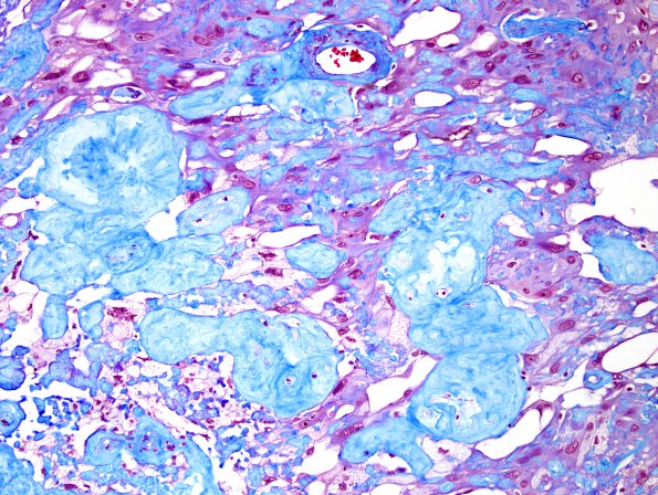 6J3 Meningioma, angiomatous, xanthomatous (Case 6) Trichrome 2.jpg