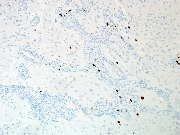 6K1 Meningioma, angiomatous, xanthomatous (Case 6) Ki67 4 (2).jpg