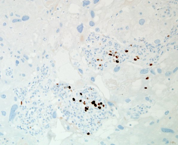 6K2 Meningioma, angiomatous, xanthomatous (Case 6) Ki67 6.jpg