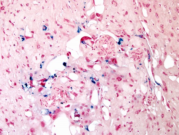 6L1 Meningioma, angiomatous, xanthomatous (Case 6) Fe 3.jpg