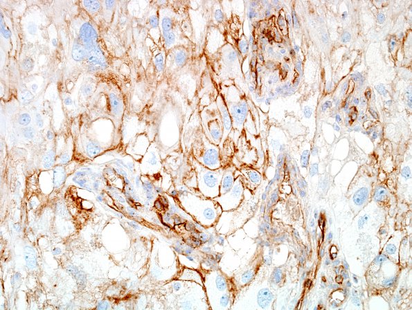 6M Meningioma, angiomatous, xanthomatous (Case 6) CD99 1.jpg