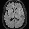 7A1 Meningioma, atypical, WHO II, sclerotic & angiomatous (Case 7) FLAIR - Copy