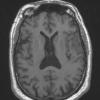 7A2 Meningioma, atypical, WHO II, sclerotic & angiomatous (Case 7) T1noC - Copy