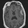 7A3 Meningioma, atypical, WHO II, sclerotic & angiomatous (Case 7) T1W - Copy