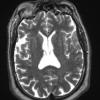 7A4 Meningioma, atypical, WHO II, sclerotic & angiomatous (Case 7) T2W - Copy