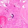 7B2 Meningioma, atypical, WHO II, sclerotic & angiomatous (Case 7) H&E 3