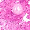 7B3 Meningioma, atypical, WHO II, sclerotic & angiomatous (Case 7) H&E 11