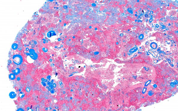 7C1 Meningioma, atypical, WHO II, sclerotic & angiomatous (Case 7) Trichrome 1