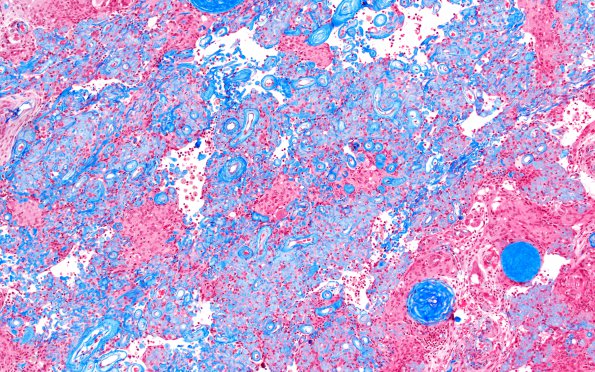 7C2 Meningioma, atypical, WHO II, sclerotic & angiomatous (Case 7) Trichrome 2