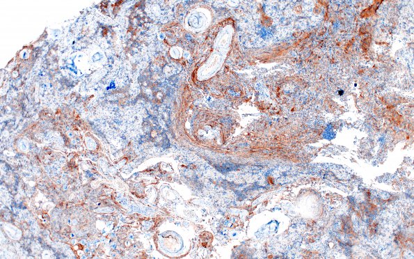 7D1 Meningioma, atypical, WHO II, sclerotic & angiomatous (Case 7) EMA 1