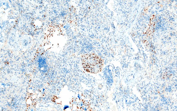 7E Meningioma, atypical, WHO II, sclerotic & angiomatous (Case 7) PR