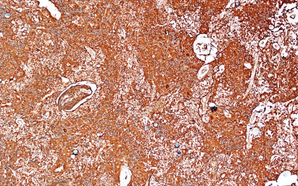 7F Meningioma, atypical, WHO II, sclerotic & angiomatous (Case 7) VIM 1