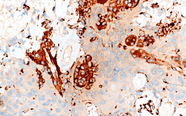 7G2 Meningioma, atypical, WHO II, sclerotic & angiomatous (Case 7) CD68 2