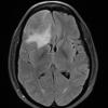 8A1 Meningioma, angiomatous (Case 8) TIRM - Copy