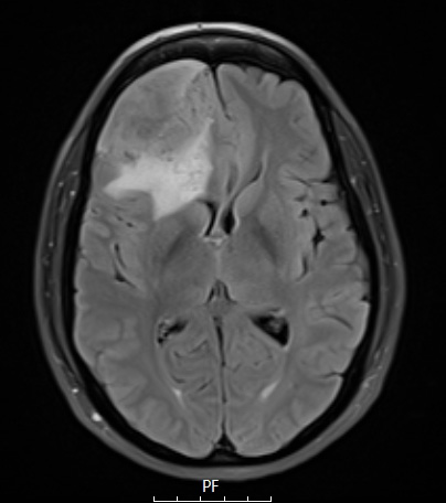 8A1 Meningioma, angiomatous (Case 8) TIRM - Copy