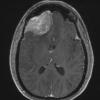 8A2 Meningioma, angiomatous (Case 8) T1W - Copy