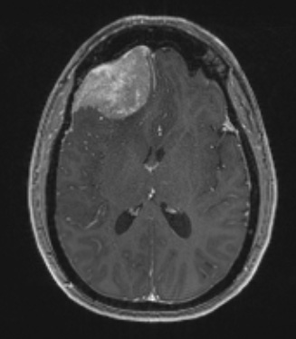 8A2 Meningioma, angiomatous (Case 8) T1W - Copy