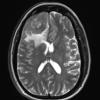 8A3 Meningioma, angiomatous (Case 8) T2W - Copy