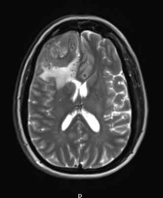 8A3 Meningioma, angiomatous (Case 8) T2W - Copy