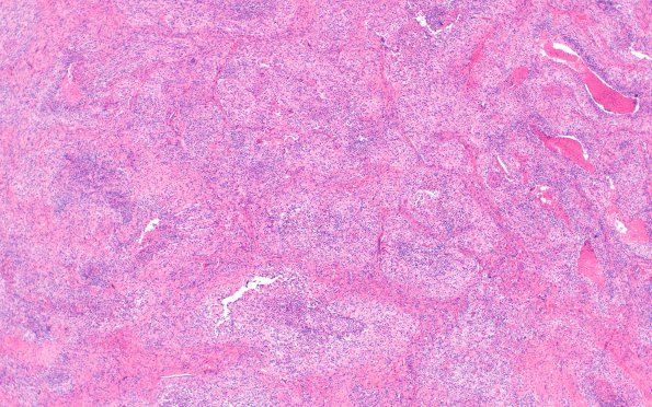 8B1 Meningioma, sclerotic (Case 8) H&E 4X (2)