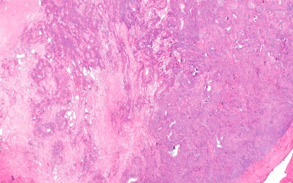 8B2 Meningioma, atypical with angiomatous (Case 8) H&E 2X (2)