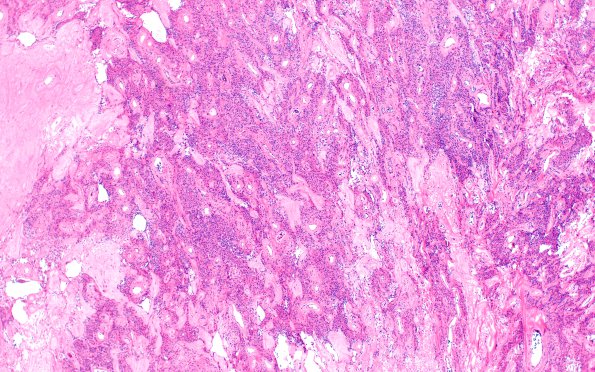 8B3 Meningioma, atypical, focal angiomatous (Case 8) H&E 4X (2)