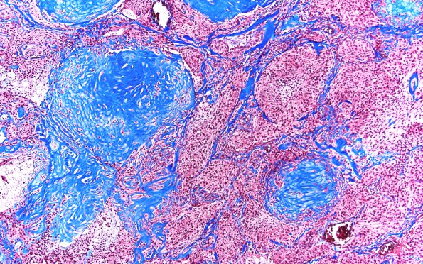 8C2 Meningioma, sclerotic (Case 8) Trichrome 2