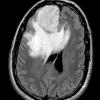 9A1 Meningioma, Microcystic Angiomatous (Case 9) FLAIR - Copy