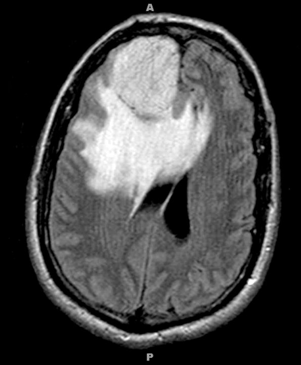 9A1 Meningioma, Microcystic Angiomatous (Case 9) FLAIR - Copy