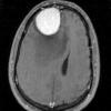 9A2 Meningioma, Microcystic Angiomatous (Case 9) T1W - Copy