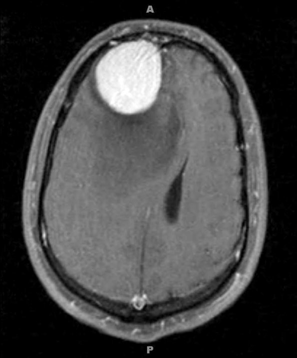 9A2 Meningioma, Microcystic Angiomatous (Case 9) T1W - Copy