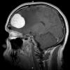 9A3 Meningioma, Microcystic Angiomatous (Case 9) MRI 2 - Copy