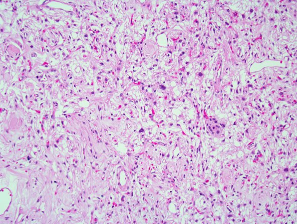 9B1 Meningioma, Microcystic Angiomatous (Case 9) 1.jpg