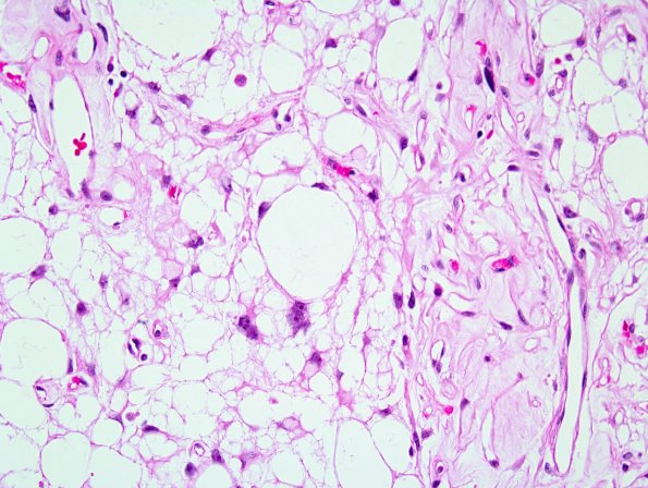 9B2 Meningioma, Microcystic Angiomatous (Case 9) 2.jpg